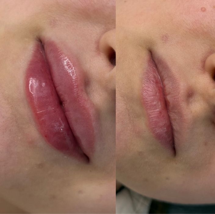 Ботокс, збільшення губ 4000 грн, косметологія