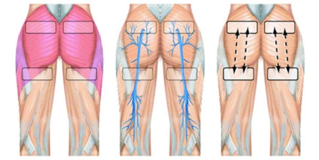 Emagrecer Electroestimulador Slendertone Bottom