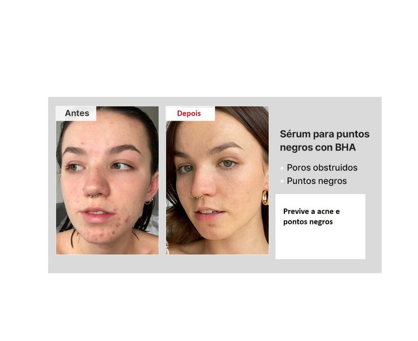 Sérum Eliminador de Pontos Negro BHA 4%