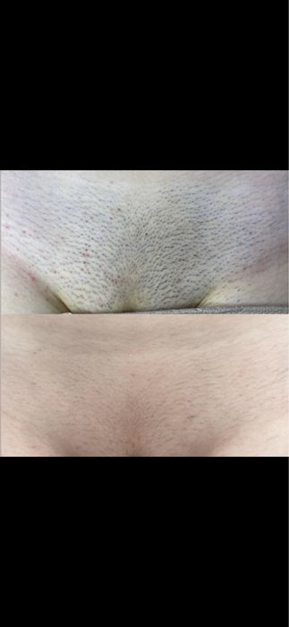 Лазерная эпиляция