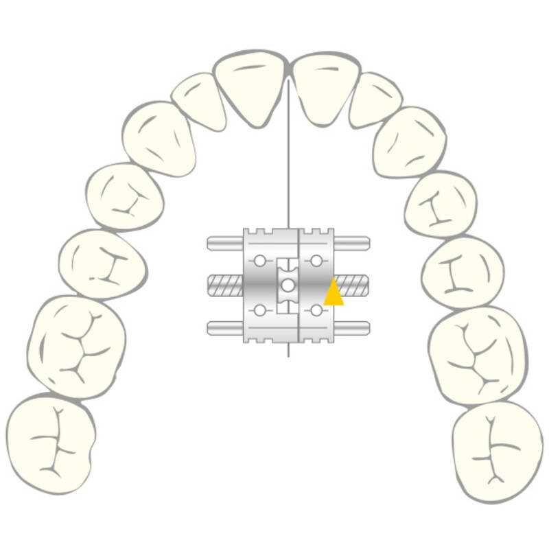 Parafusos Vector 200 marca Scheu 98 unidades Ortodoncia