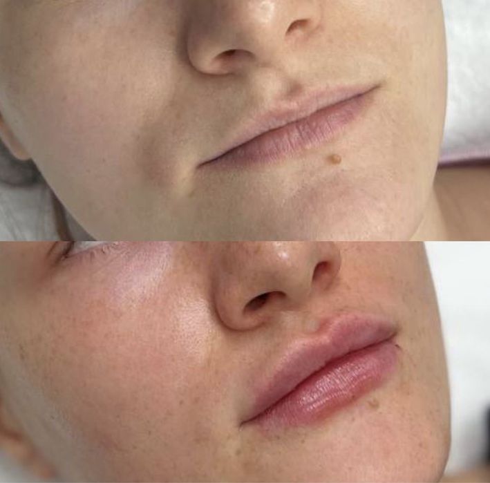 Косметолог Контурная пластика Славянск