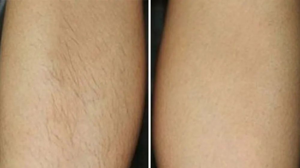 Zabieg Depilacji Laserowej / Endermologii -30% na wszystko