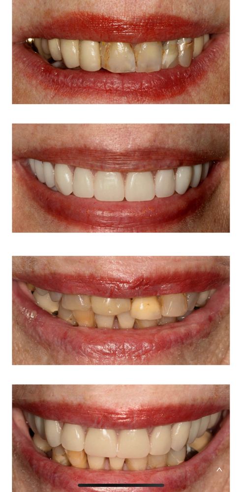 Implante dentario (450€)
