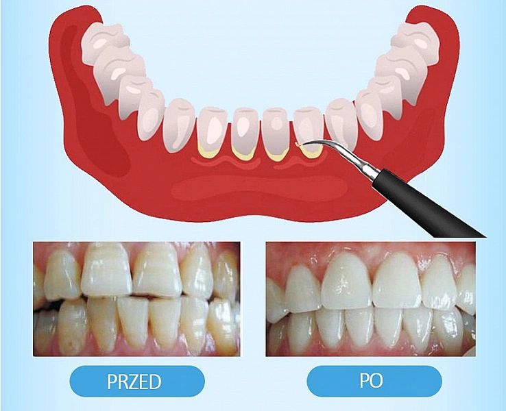 Elektryczny Skaler Soniczny Usuwa kamień nazębny