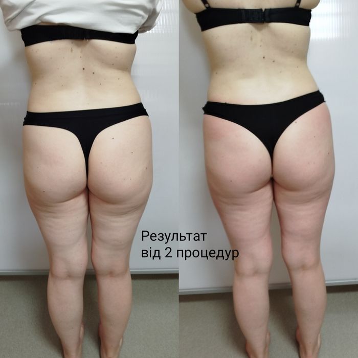 Антицелюлiтний, класичний масаж