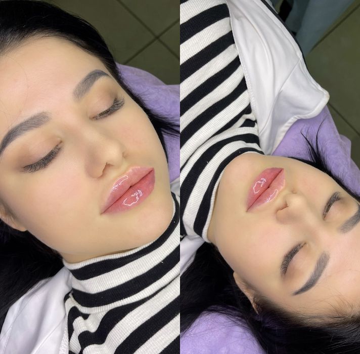 Ботокс/Контурная пластика губ