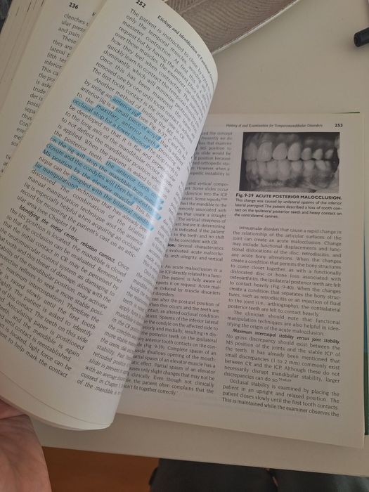 Management of Temporomandibular Disorders and Occlusion Okeson