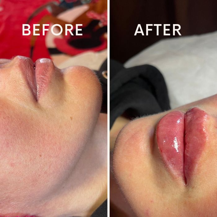 Контурна пластика губ від 3000 ботокс 1000