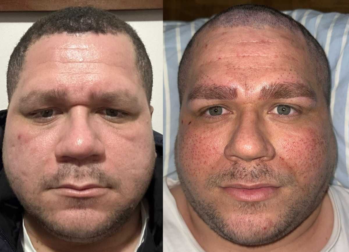 Skimbooste ( Rejuvenescimento)
