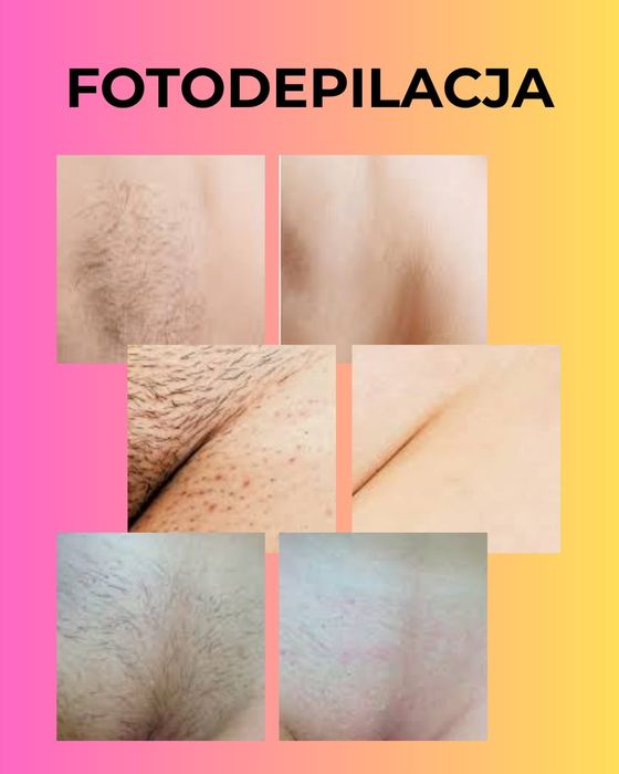 Depilacja laserowa, usuwanie przebarwień, włókniaków, redukcja zmarszc