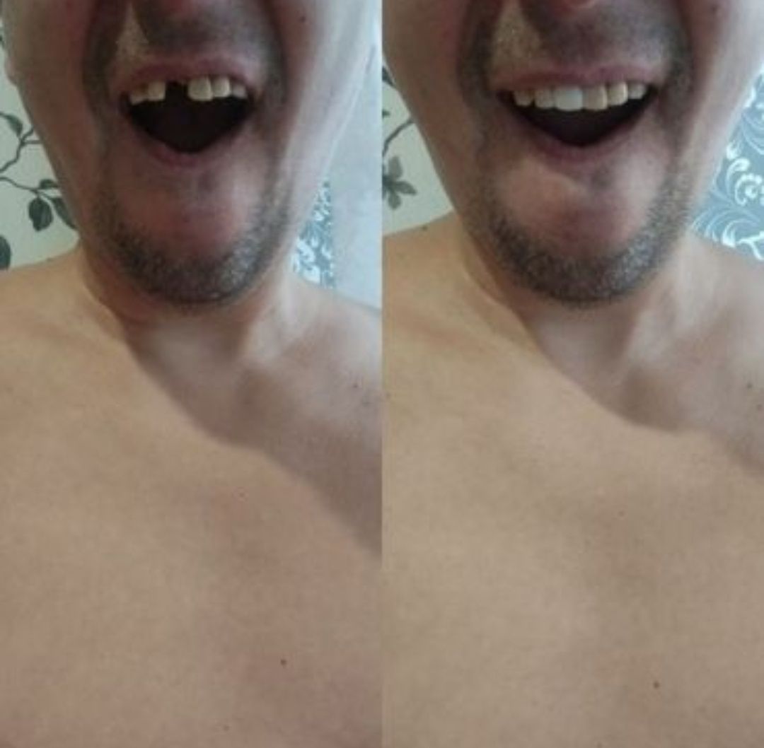 Resina Dentária! Dentaduras, Dentes em Falta e Espaços Entre os Dentes