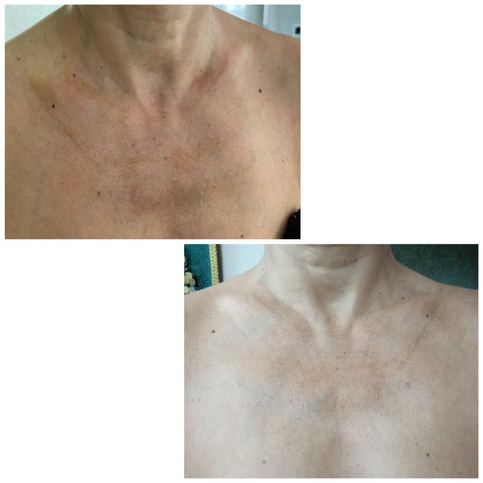 Холодна плазма НОВА розробка вчених Косметологічний апарат