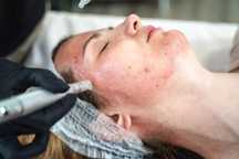 Mezoterapia Dermapen / mikrodermabrazja / kwasy/ lifting rzęs MODELKI