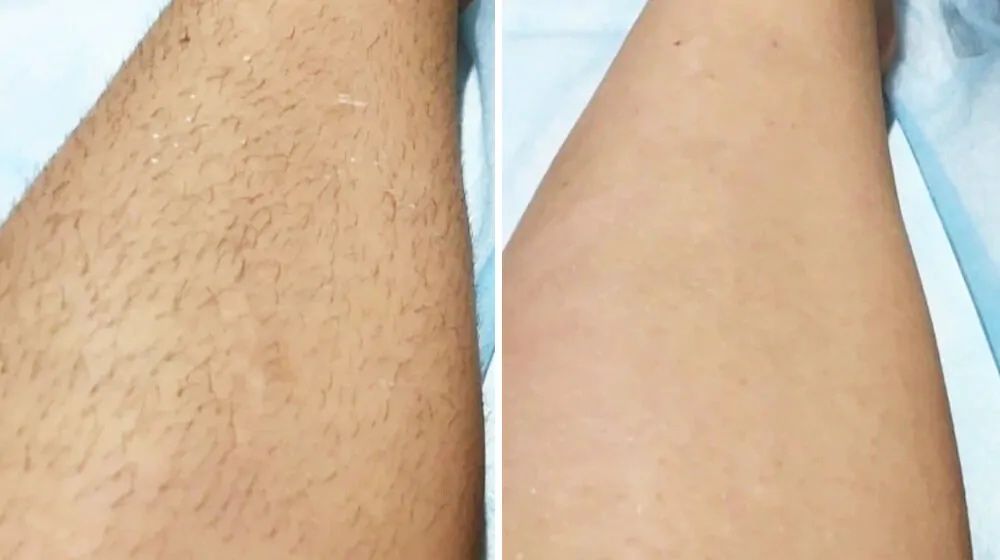 Лазерна епіляція