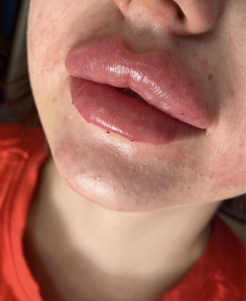 Powiększanie ust RUSSIAN LIPS 1ml 600zl, botox,dolina łez, mod.brody