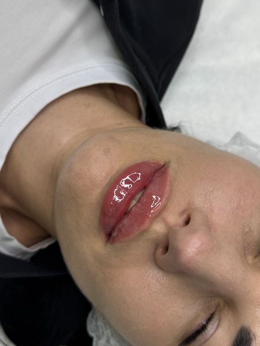 Збільшення губ,ботокс,мезотерапія,біоревіталізація,чистка обличчя