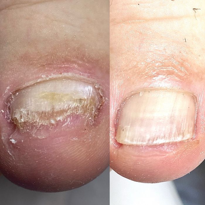 Подолог. Медичний педикюр