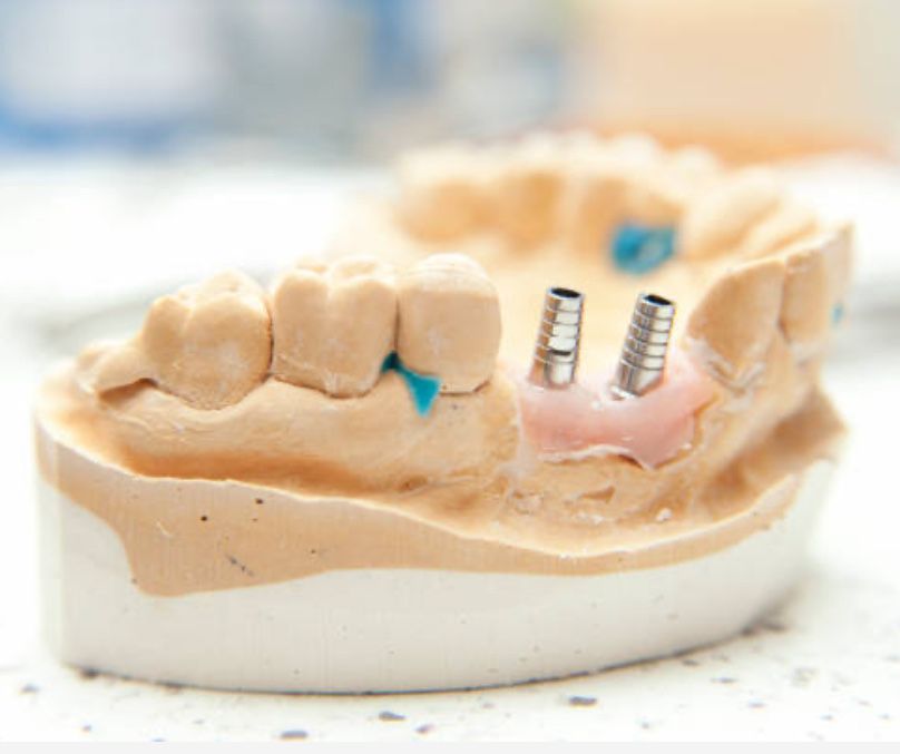 Implante dentario (450€)