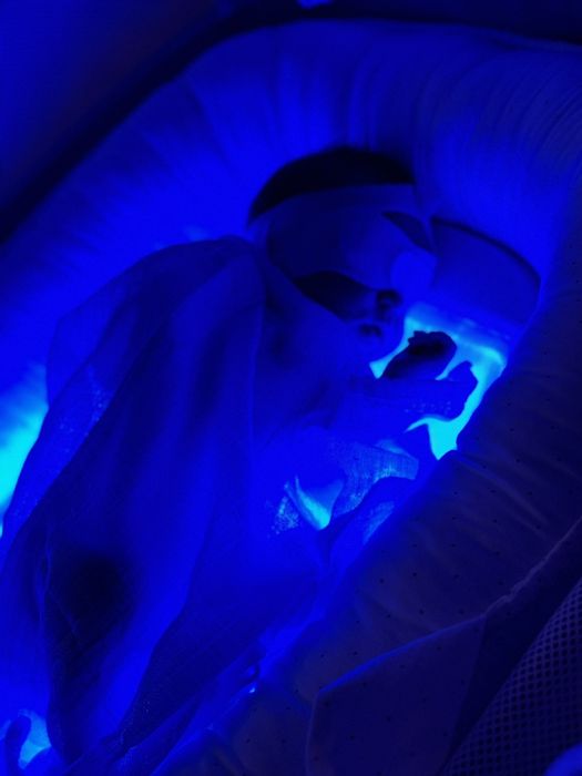 Лампа от жовтяниці,лікування жовтухи,фотолампа,білірубін