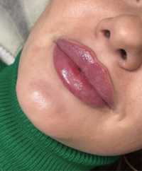 Увеличение губ