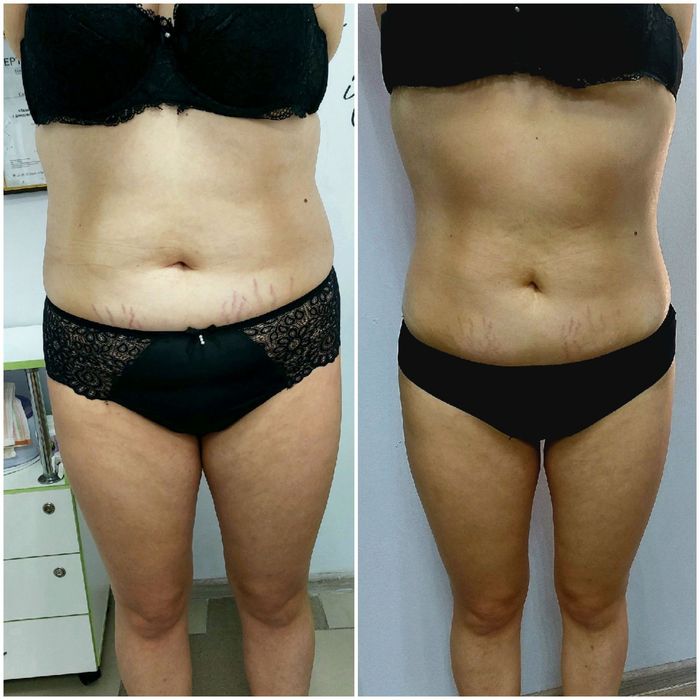 Массаж , лазерная эпиляция, пресотерапия Горняцкий ,Червоная