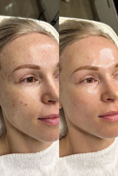 Zabiegi na przebarwienia + zmarszczki + lifting dojazd GRATIS Świętokr