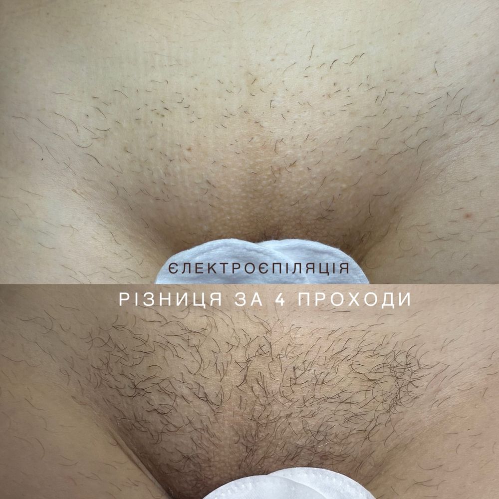 Электроэпиляция удаление волос  обучение Победа 4 электро