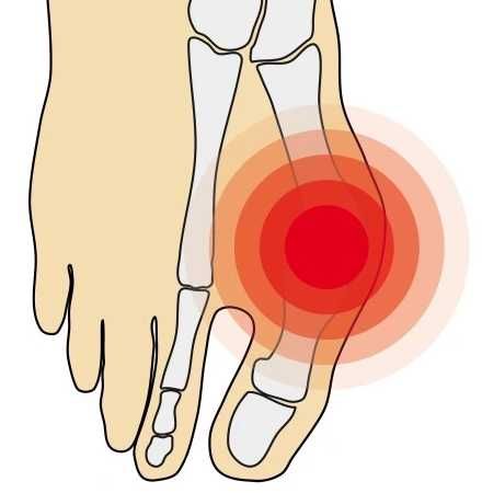 Arthrolux bandaż Skarpety korekcyjne na haluks  S 34-36 kolor czarny