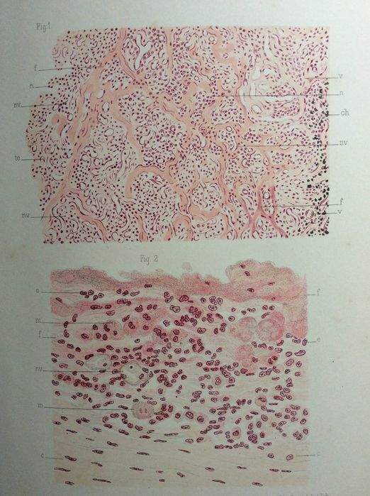 L'Inflammation. Études anatomo-pathologiques, 1893