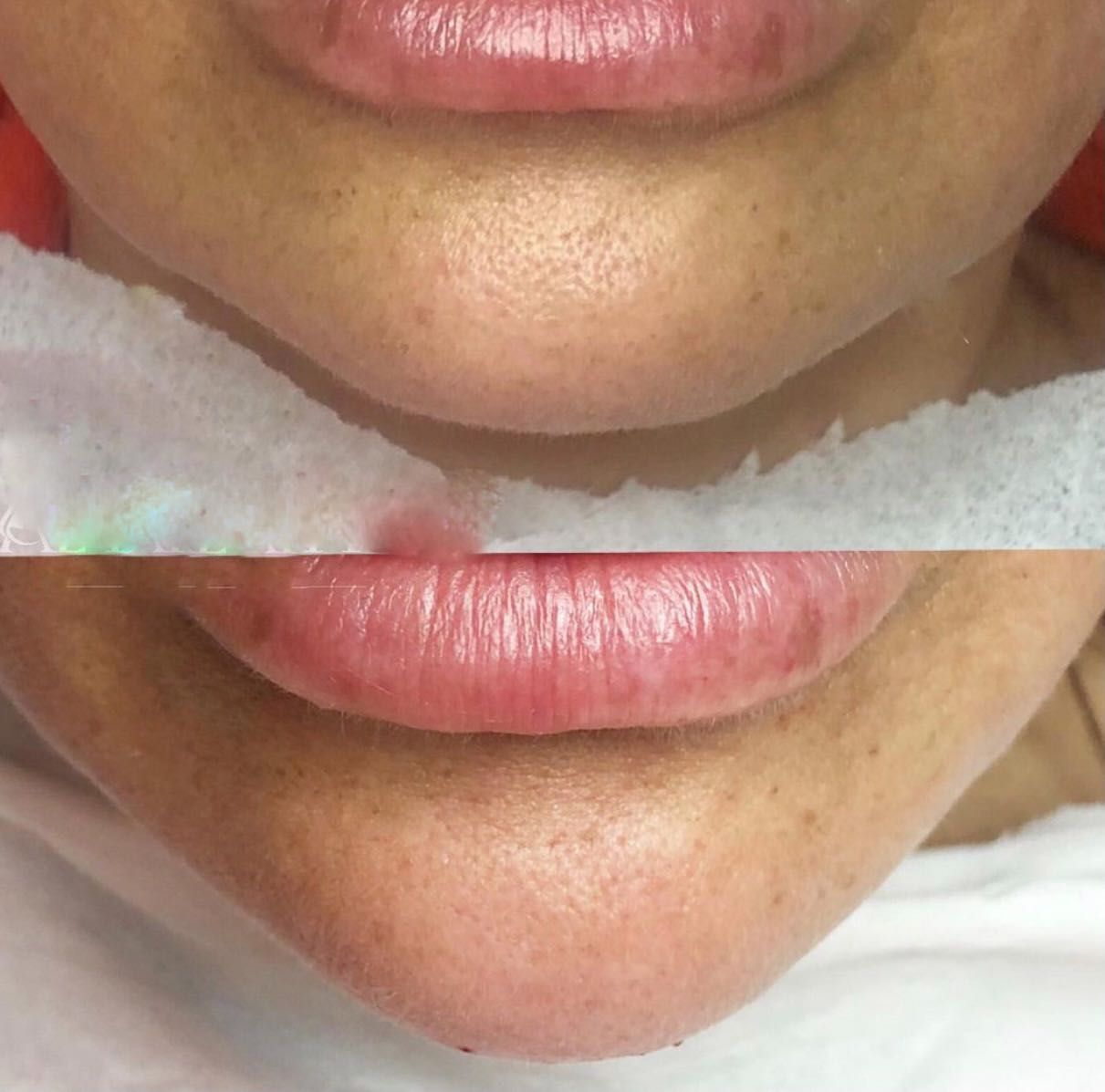 Powiększanie usta RUSSIAN LIPS , NA PLASKO 1ml 600zl, botox