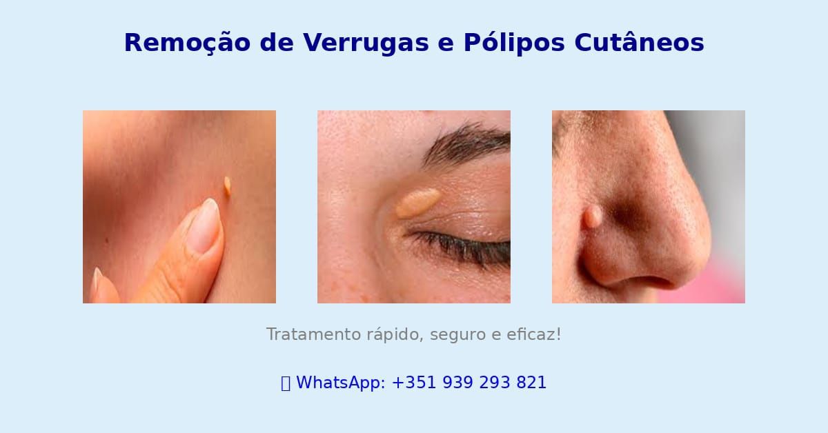 Remoção com cauterização jato de plasma