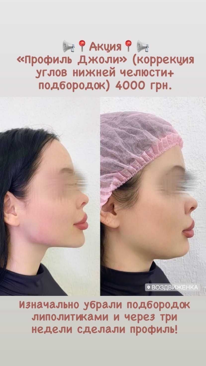 Увеличение губ от 1800 грн. ЭФФЕКТИВНО И НЕДОРОГО!