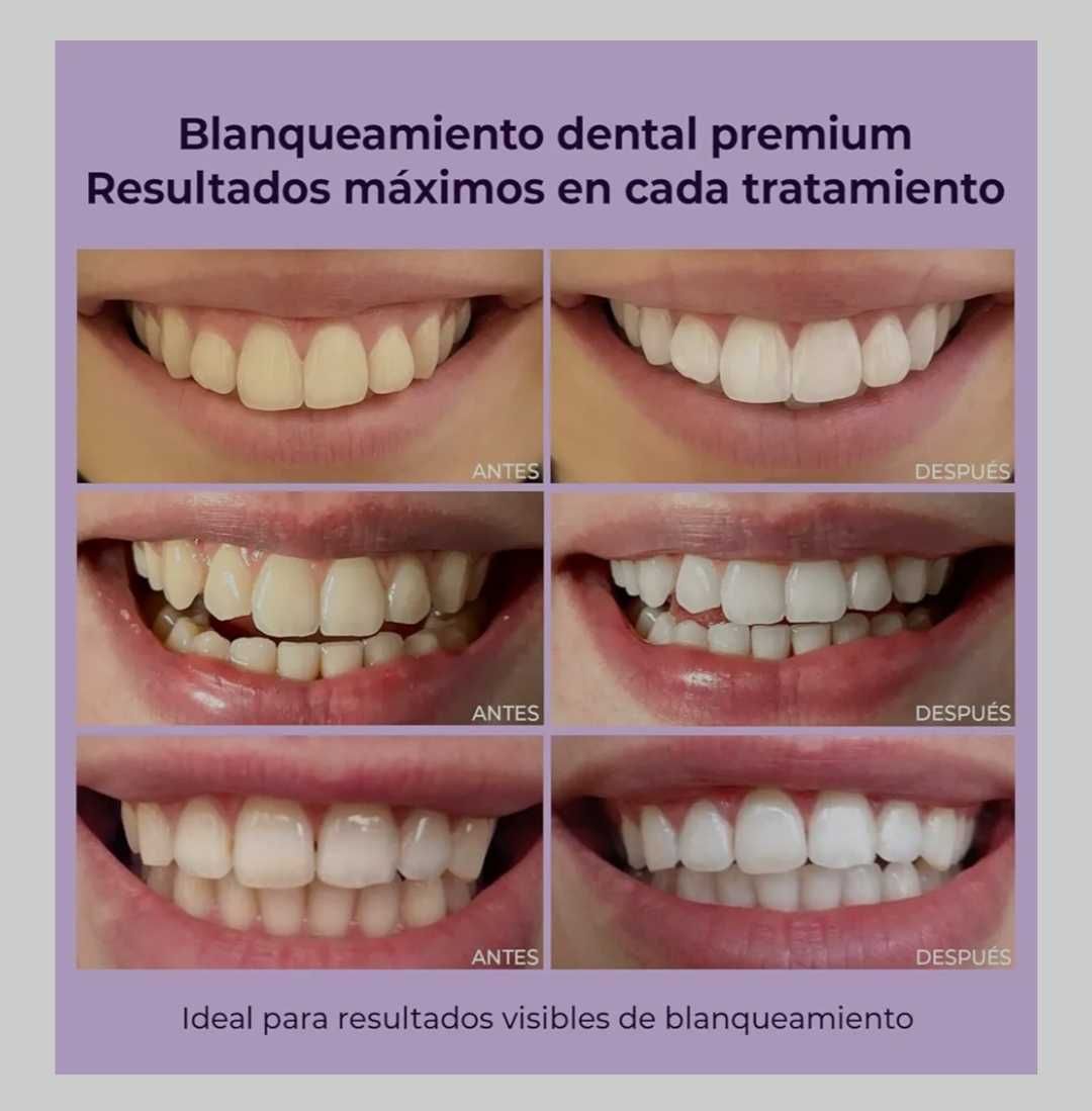 OnlySmile Kit Branqueador dentário profissional selado