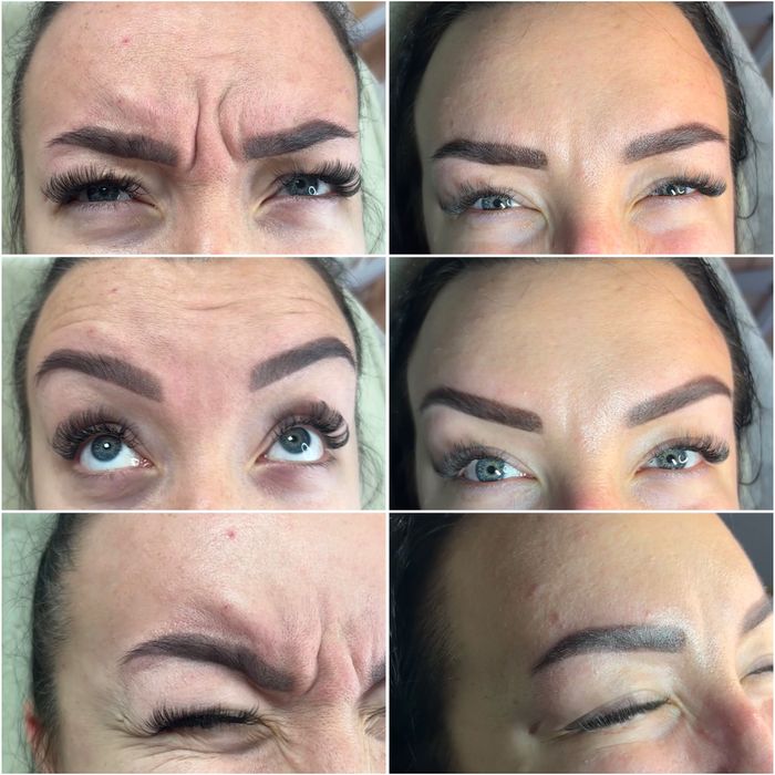 Безкоштовно збільшення губ / контурна пластика губ / ботокс