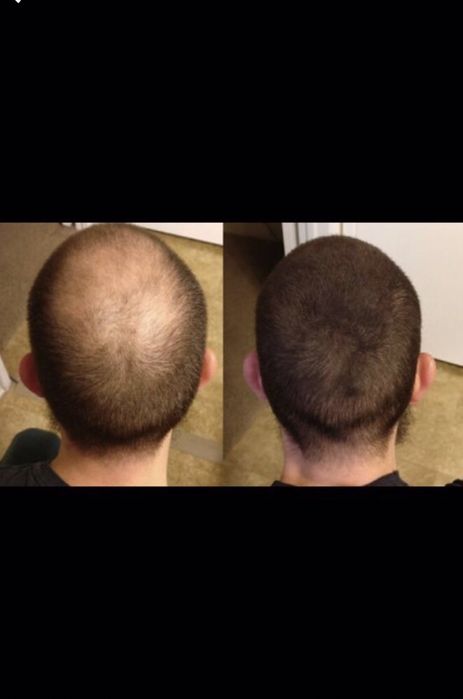 Fibras Toppik para calvície instantâneo