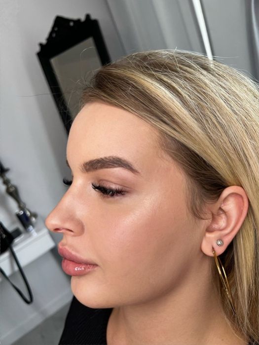 Super Promocja 450zł Modelowanie powiększanie ust wyrównanie asymetrii