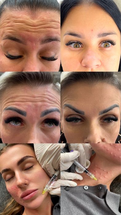 Моделі на ботулінотерапію та біоревіталізацію