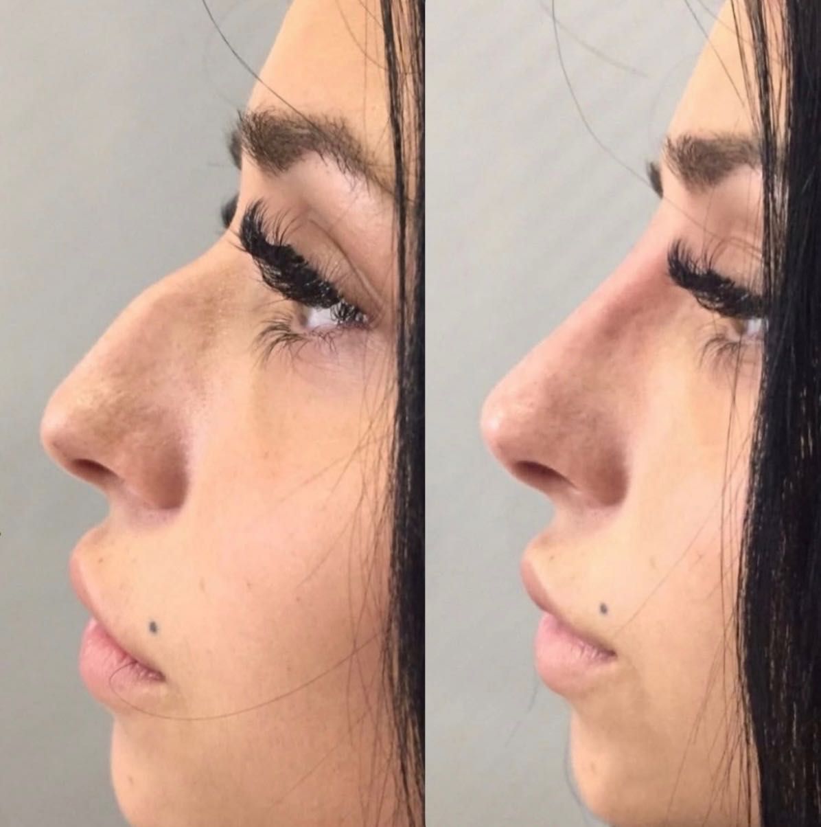 Botox/fullFace/контурная пластика/ губы