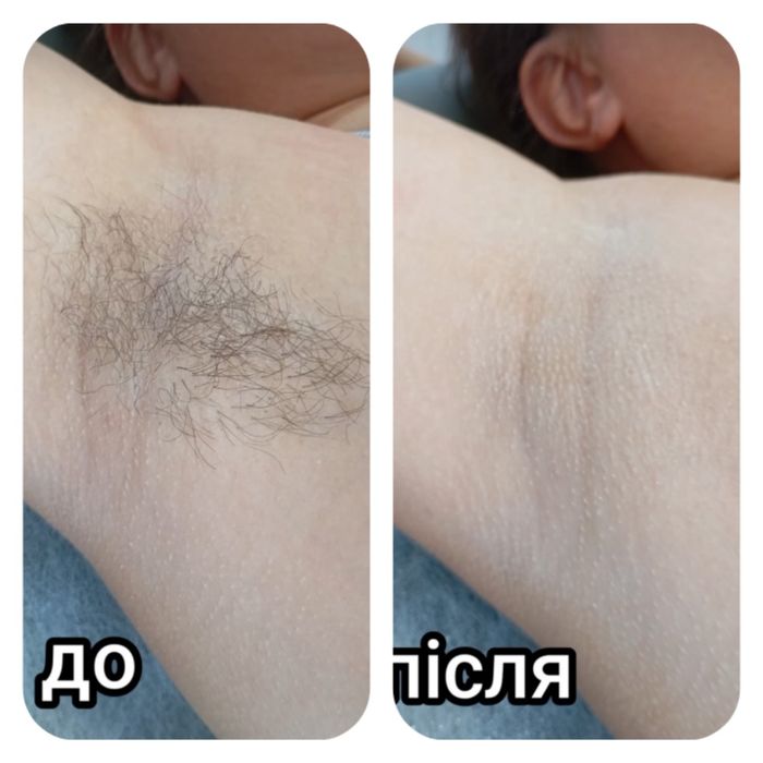 Воскова депіляція