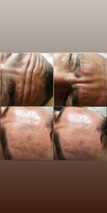 Косметолог Київ, Працюю!!  Акція Ботокс 2500 3 зони.