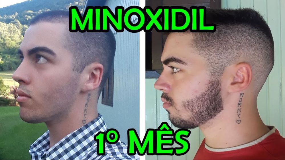 Minoxidil! Fim da calvície ! Crescimento de barba