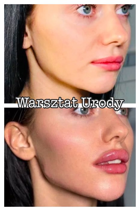 250zł= Botox Botoks kwas hialuronowy Wolumetria Powiększenie Ust 300zł