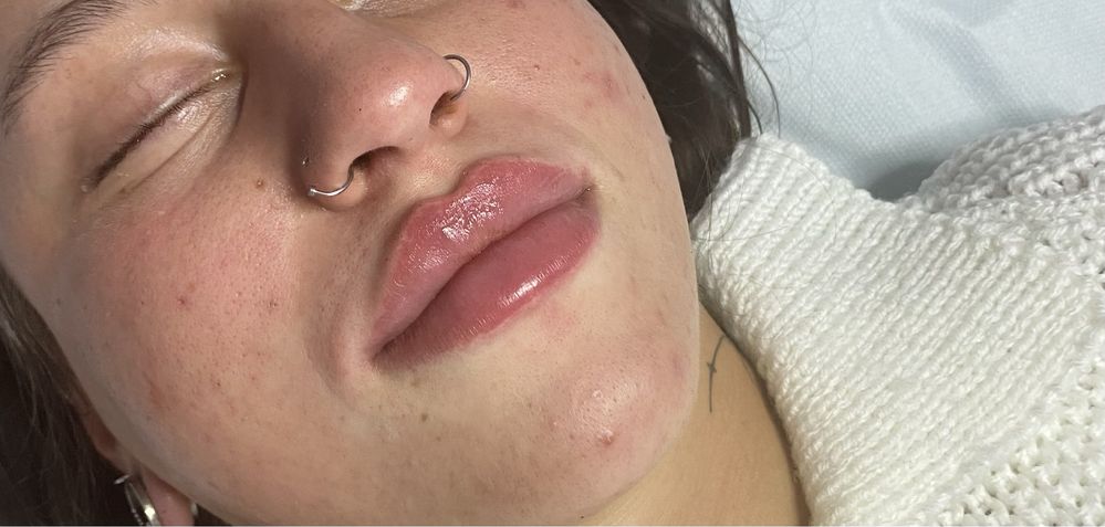 Powiększanie ust na płasko 1ml350zł,2ml450zł,botox,niciPDO4D,lipoliza,