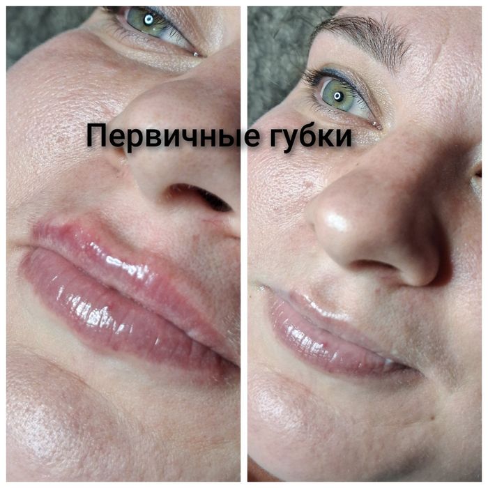 Косметолог Кривой Рог(губы, ботокс,чистка лица)