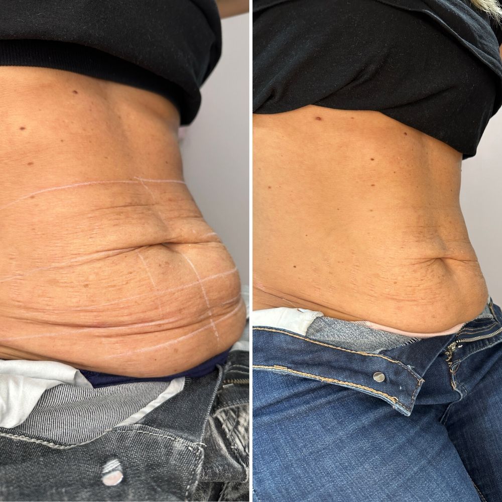 Medycyna estetyczna Modelowanie ust Wolumetria Botoks Stymulatory