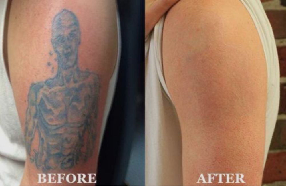 Tecnica de remocao de tatuagem, branqueamento intimo e peeling