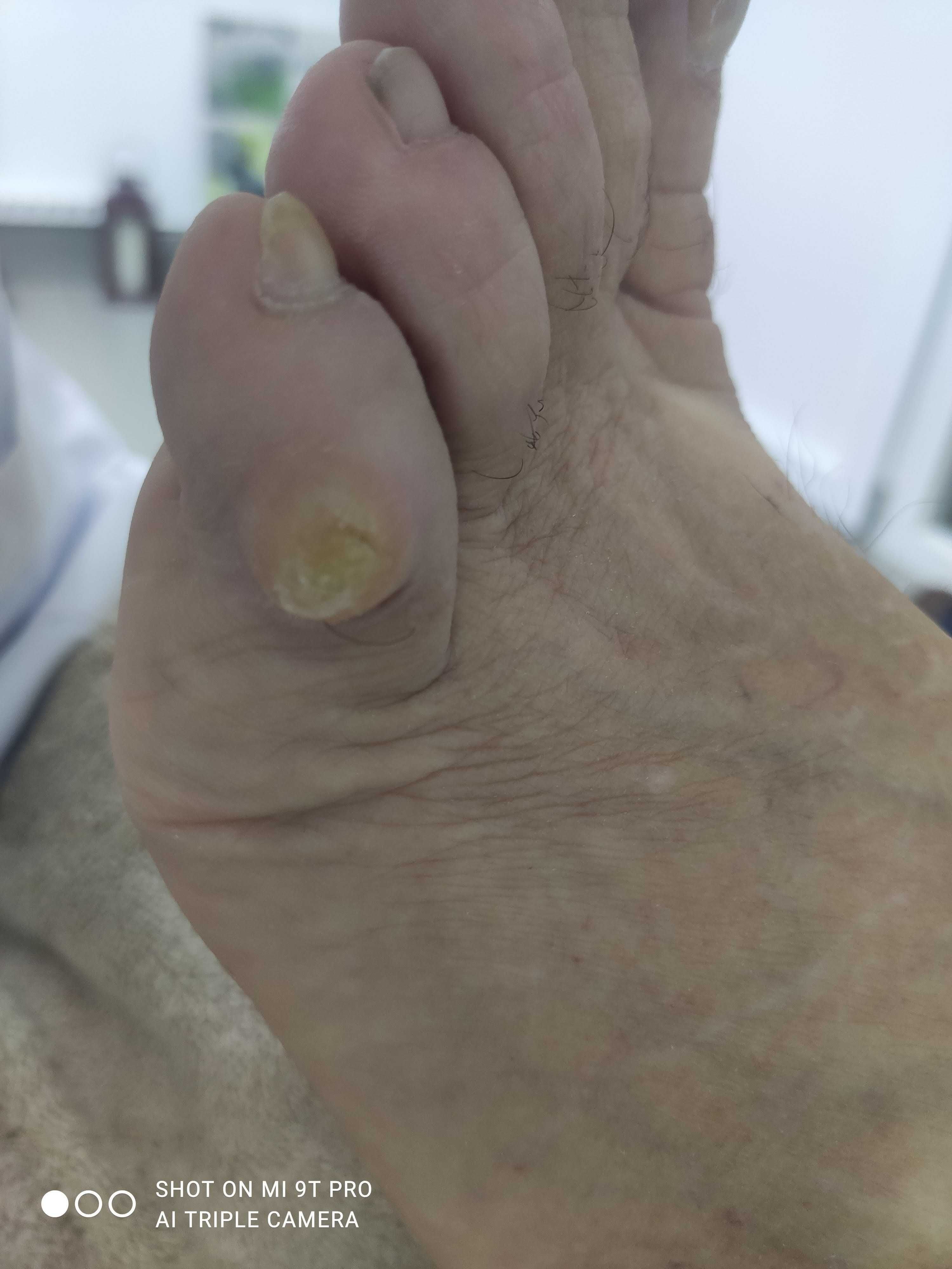 TRATAMENTO DE CALOS/UNHAS ENCRAVADAS (masculino/feminico)