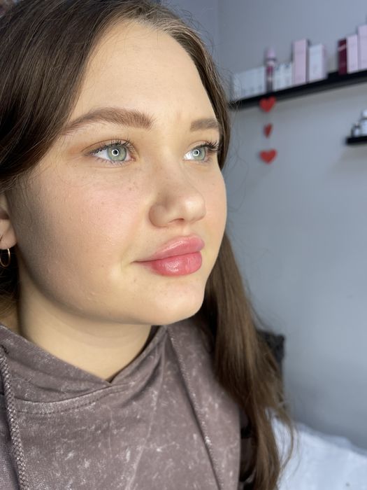 Контурна пластика губ від 3000 ботокс 1000