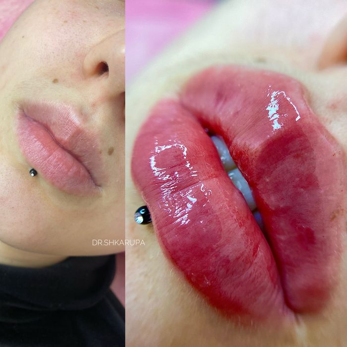 АКЦІЯ! Контурна пластика губ / збільшення губ / увеличение губ